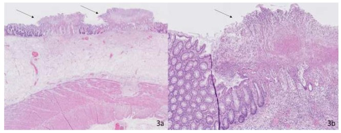 Fulminant clostridioides difficile colitis in an obese patient with ...