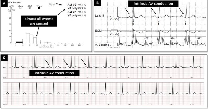 Optimizing atrioventricular synchrony in young adults implanted with ...